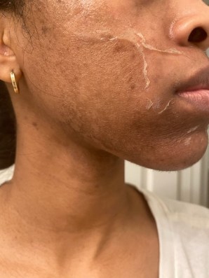 Mild to medium flaking/peeling will occur. Peeling is a good sign! The dead skin, acne, and/or dark spots are shedding off overtime to reveal a fresh layer of skin.
