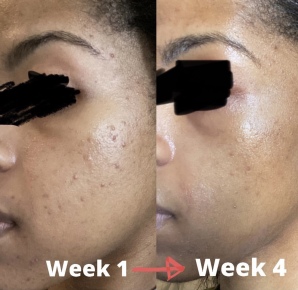 The Hydrating Depigmentation Peel in progress