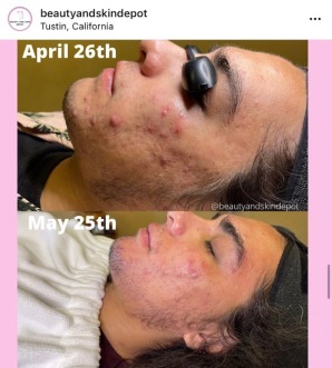 The Acne Peel 30 day progress