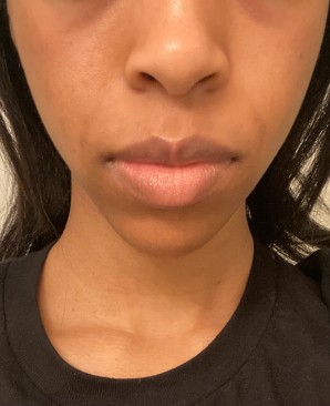 Week 7 progress from the hyperpigmentation peel. Lifting stubborn hyperpigmentation takes time.