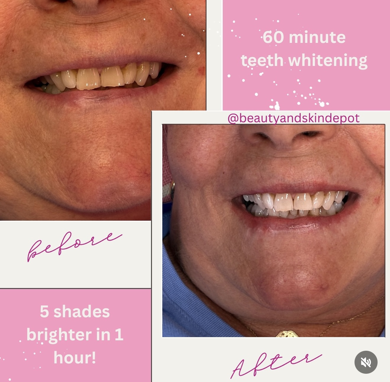 Teeth whitening before and after