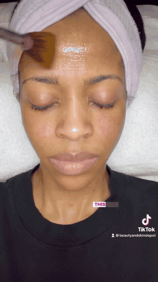 Lactic Acid Peel Application