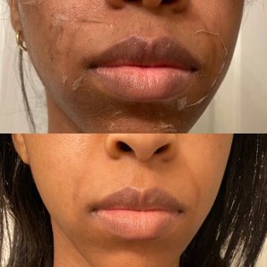The Hyperpigmentation Peel in progress