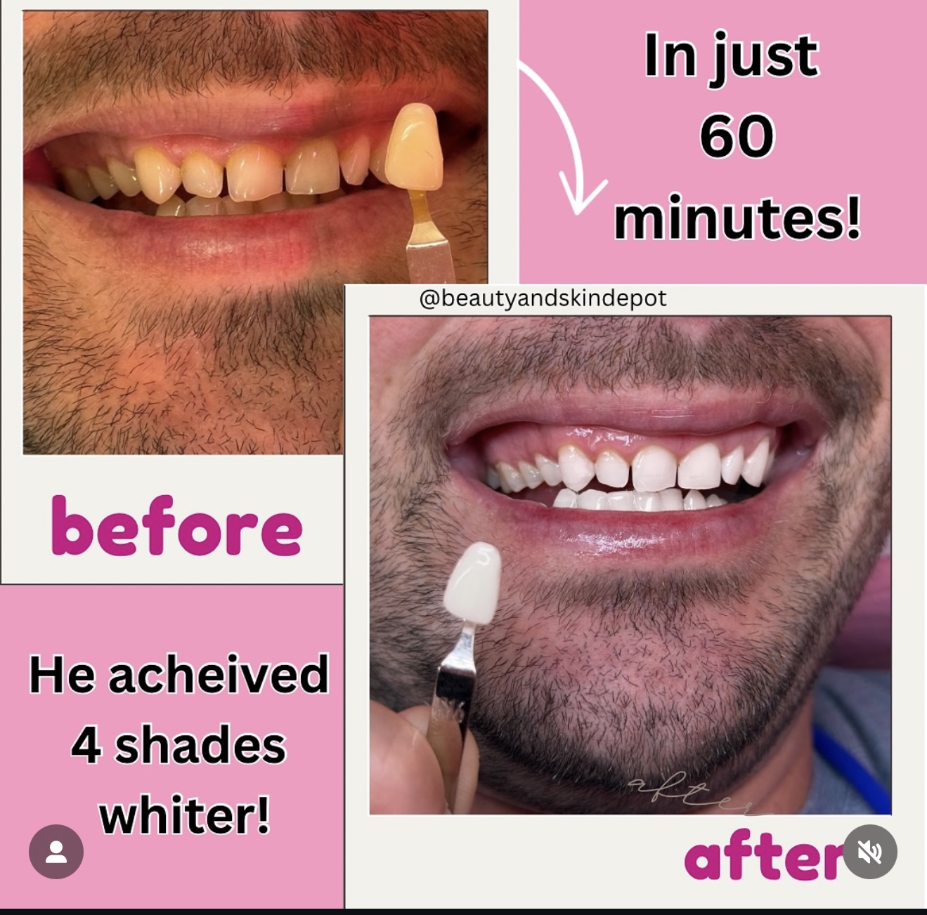 Teeth whitening before and after